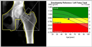DEXA Scan: 3 Reasons to Get One - Proximal50